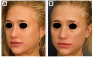 Figure 4 Facial feminisation using the five-star technique. (A) Before and (B) after