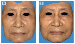 Figure 1 Patient 2 — transformed three-dimensional image between (A) preoperative baseline image and (B) 7-months after the stem cell facelift procedure