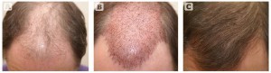 Figure 1 Male hair transplant (A) before, (B) during, and (C) after