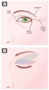 Figure 1 (A) anatomical features around the eye and (B) illustration of different types of skin excision. The Rees classical drawing is in green, and the authors’ technique is in blue