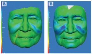 Figure 2 Patient 2 — three-dimensional colourimetric analysis demonstrating areas of volume change (blue) over time. Increasing depth of blue represents increased volume. Between (A) 2 months and (B) 7 months post‑procedure. The 83 year-old female was very pleased with the results