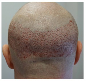 Figure 2 Follicular unit extraction (FUE) donor