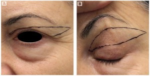 Figure 2 (A) Preoperative drawing with the eye open and (B) the skin of the eyelid stretched upward