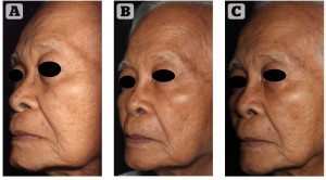 Figure 3 Patient 1 — two-dimensional images over time. (A) Before stem cell facelift, (B) 2 months, and (C) 7 months post-procedure