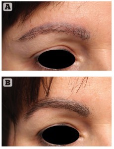 Figure 3 Eyebrow hair transplant (A) before, and (B) after