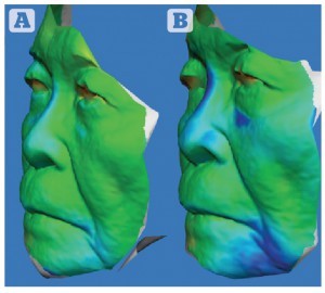 Figure 4 Patient 1 — three-dimensional colourimetric analysis demonstrating areas of volume change (blue) over time. Between (A) 2 months and (B) 7 months post‑procedure. The 83 year-old male was very pleased with the results