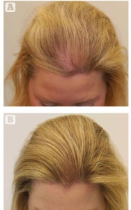 Figure 4 Female hair transplant (A) before, and (B) after