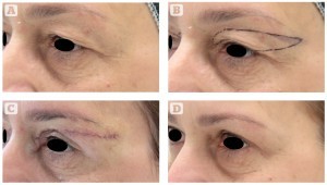 Figure 4 (A) This 50-year-old woman presented for rejuvenation of the eyelid area and correction of lateral hooding. (B) The patient’s preoperative markings. (C) Shortly after the operation (10 minutes). (D) 6 months after upper blepharoplasty using the authors’ technique