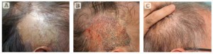Figure 5 Hair transplant into a burn scar (A) before, (B) during, and (C) after