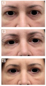 Figure 5 (A)This 48-year-old woman presented for rejuvenation of the eyelid area and correction of lateral hooding. (B) The patient’s preoperative markings. (C) 6 months after upper blepharoplasty using the authors’ technique
