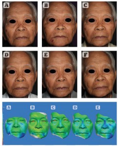 Figure 6 Patient 1 — top: series of two-dimensional images over time. Bottom: three-dimensional colourimetric analysis demonstrating areas of volume change (blue) over time. (A) 24 hours, (B) 1 month, (C) 2 months, (D) 3 months, and (E) 7 months. Between (B) month 1, and (E) month 7, there was a 205.95% increase on the left and 186.29% increase on the right