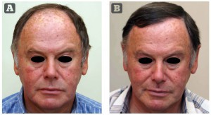 Figure 6 (A) Before hair transplant and (B) rejuvenated appearance after hair transplant