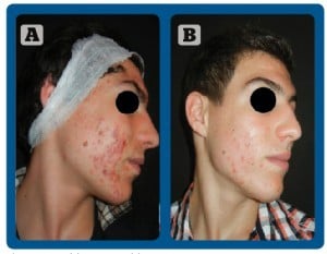 Figure 1 (A) before and (B) after 3 treatments with D-Glow