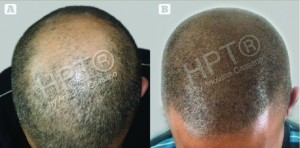 Figure 1 Hair microPigmentation Treatment (HPT) for male pattern baldness. (A) Before HPT and (B) after HPT