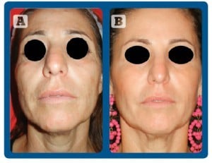 Figure 2 (A) before and (B) after 3 treatments with D-Glow