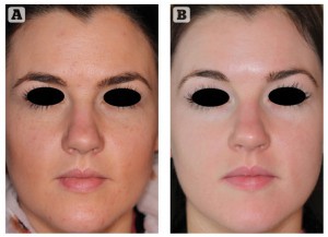 Figure 2 30-year-old female with rosacea treated for 18 weeks with ZO Medical (ZO® Skin Health, Irvine, CA) and oral isotretinoin (20 mg daily). (A) Before and (B) after treatment