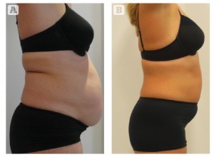 Figure 2 Patient 4, (A) before and (B) after the weight-loss programme