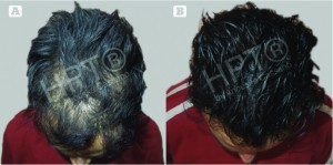 Figure 2 Hair microPigmentation Treatment (HPT) with hair restoration surgery. (A) Before HPT and (B) after HPT