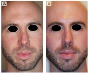 Figure 3 32-year-old male with rosacea treated for 18 weeks with ZO Medical (ZO® Skin Health, Irvine, CA) and oral isotretinoin (20 mg daily). (A) Before and (B) after treatment