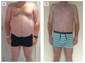 Figure 3 Patient 7 (A) before and (B) after the weight-loss programme