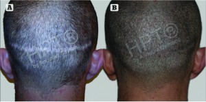 Figure 3 Hair microPigmentation Treatment (HPT) for transplant scarring. (A) Before HPT and (B) after HPT