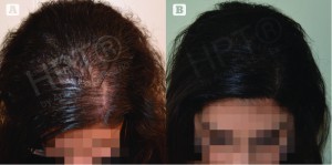 Figure 4 Hair microPigmentation Treatment for female hair loss. (A) Before HPT and (B) after HPT