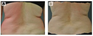 Figure 2 A) Before, and B) 4 months post liposuction procedure to the abdomen, flanks, upper back, lateral and medial thighs, knees, and arms. Total fat aspirate removed was 4500 cc or 9 lbs