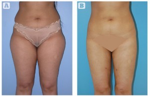 Figure 3 A) Before and (B) 4 months post-op large volume liposuction of lower body