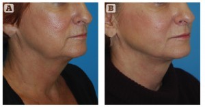 Figure 4 A) Before and (B) 4 month post-op neck and jowl liposuction