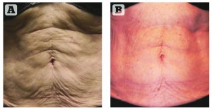Figure 1 A) before and B) after 10 treatments to the abdomen with Venus Legacy™
