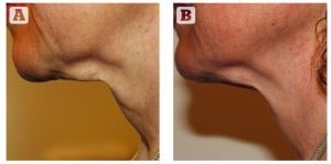 Figure 2 A) before and B) after 6 treatments to the neck with Venus Legacy™