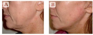 Figure 10 (A) Jaw line prior to insertion of two Silhouette Soft threads. (B) Jaw line Post insertion of two Silhouette Soft threads.