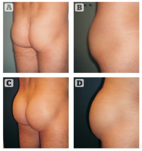 Figure 1 Buttock augmentation with oval implants, 240 cc. (A, B) before and (C, D) after 