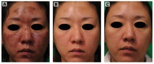 Figure 1 The best responder to LFQS. Patient was 37 years old and acquired PIH after fractional laser treatment, which had been performed 4 weeks before her visit. She showed an excellent clinical result after LFQS treatment. (A) Before treatment, (B) 2 weeks after fifth LFQS treatment, (C) 1 month after tenth session