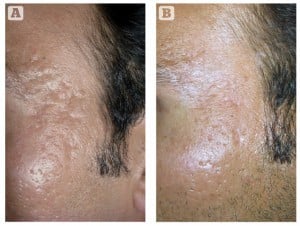 Figure 1 (A) Rolling acne scars on the forehead, and (B) excellent response after four sessions of microneedling