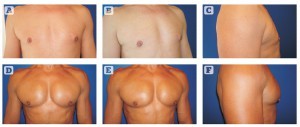 Figure 2 Pectoral implants, 190 cc (Polytech Health & Aesthetics, Dieburg, Germany). (A, B, C) Before and (D, E, F) after
