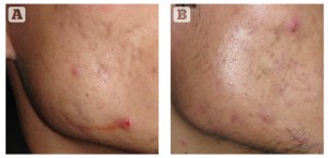 Figure 2 (A) Rolling acne scars on cheek, and (B) reduction in scars after 3 sessions of microneedling