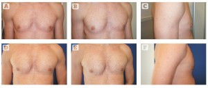 Figure 3 Chest enhancement with custom-made implants.  (A, B, C) Before and (D, E, F) after