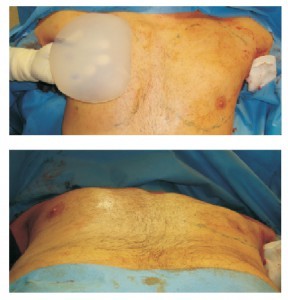 Figure 4 Intraoperative view of chest enhancement using a custom-made implant to get a more square look and define the whole contour 