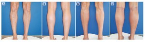 Figure 5 Calf augmentation, submuscular. Two implants in each leg (Montellano medial  of 140 cc and lateral of 85 cc). (A, B) before and (C, D) after