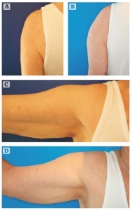 Figure 6 Deltoid augmentation, 110 cc oval (A) and (B) before treatment; and )C) and (D) after treatment. The new contour is seen with the arm adducted, and remains natural when abducted, without unduly and obvious convexity