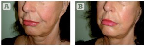 Figure 8 Insufficient result on the nasolabial fold after two surgical facelifts, prior to insertion of two Silhouette Soft threads per side. (B) very good result on the naso-labial fold after insertion of 2 Silhouette Soft threads per side 