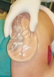 Figure 7 Oval implant, 240 cc, for unilateral triceps augmentation after injury