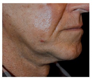 Figure 7 Granulomatous reaction around an intradermal cone to superficial insertion