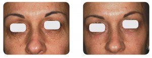 (Left) Baseline: A 37-year old female patient, skin type III. Presents syringomas plus moderate skin laxity of the lower eyelids. (Right) Postoperative Results - 6 months post one session. Combination of SurgiTouch™/AcuScan120™  