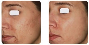 (Left) Baseline: A 27-year old female patient, skin type IIIa. Presents mixed acne scars mostly on the cheeks. (Right) Postoperative Results: 6 months post one session.