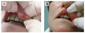 Figure 2 Patient with lip nodules after injection with Bio-Alcamid (Polymekon, Brindisi, Italy)