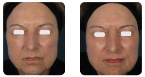 (Left) Baseline: A 52-year old female patient, skin type II. Presents mild to moderate photo aging signs on the full face, with marked peri-oral rhytids. (Right) Postoperative Results: 6 months post one session. Combo mode using the AcuScan120™.  