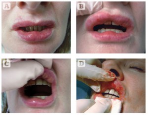 Figure 3 (A–C) BioAlcamid nodules. (D) A 23G needle was used to incise the lips and the compound was expressed  