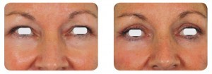 (Left) Baseline: A 49-year old female patient, skin type III. Presents marked symmetric and bilateral dermatochalasia on the upper lids. Moderate festooning was noted of the lower eyelids with mild skin laxity. (Right) Postoperative Results: 3 months post one session. The entire ellipse of skin was elevated and incised with laser. A thin strip of orbicularis oculi muscle was excised in order to expose the orbital septum. The defect in the orbital septum was identified and herniated orbital fat was exposed. The festooning fat pads in the medial lower lid were exposed through a conjunctival approach and excised with laser, after which the stalk was meticulously cauterized with laser in a defocused mode.
